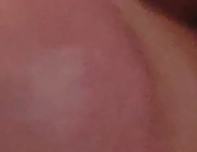 Immense Phimosis Being Extracted Cum and Précum.