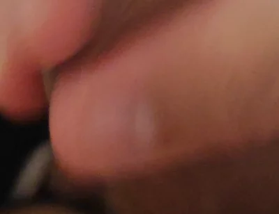 Immense Phimosis Being Extracted Cum and Précum.
