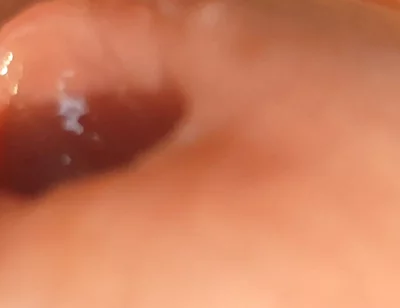 The Great Transformation of Phimosis Elastica.