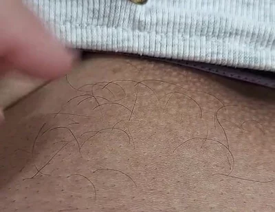 The Hair on My Penis - Led Hair Removal