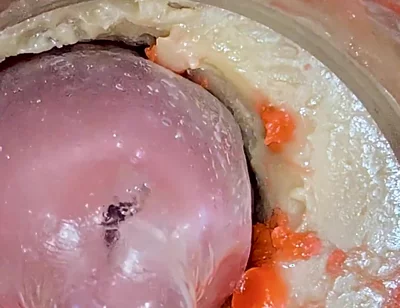 The Camera 4K Inside the Deep Pussy Records a Huge Ejaculation with a Stuck Condom