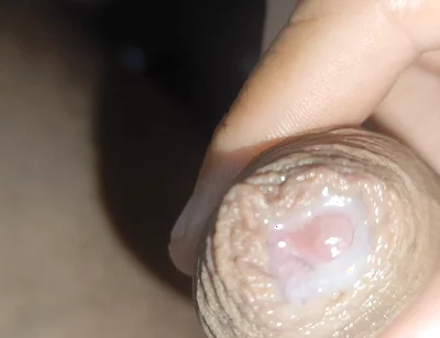 I Have the Largest Ejaculating Phimosis in the World!!
