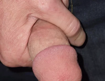 Gaping Urethra - Marker and Pinky Insertion