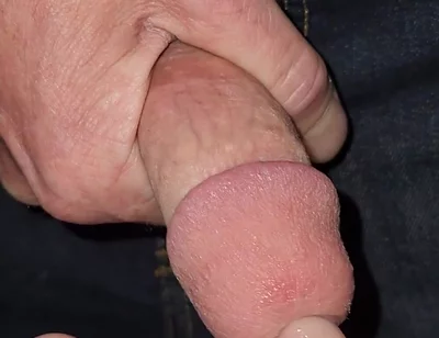 Gaping Urethra - Marker and Pinky Insertion