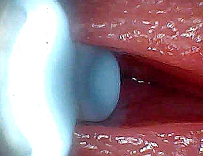 I Couldn’t Believe What Happens Inside the Penis as Sperm Passes Through (endoscopic Footage)