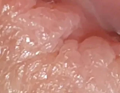 Enlargement of the Deep Urethral Hole!!