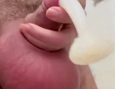 Inflated Ball Sack with Saline