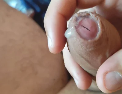 Dilation of the Corpus Cavernosum Exposes Spongy Foreskin.