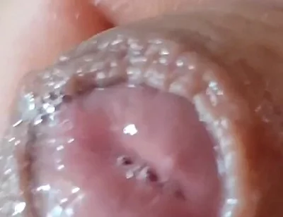 Deep Split in the Glans Produces Bubbling Liquid