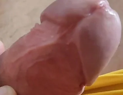 Scarred Frenulum Causes Glans Erection!
