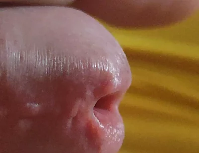 Scarred Frenulum Causes Glans Erection!
