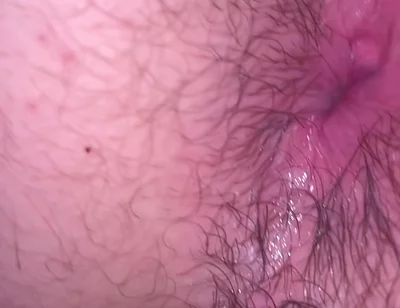 Bruised Asshole