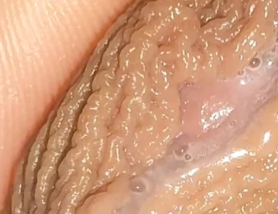 Curious Close-up of Pre-cum in Flaccid Phimosis.