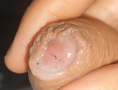 Curious Close-up of Pre-cum in Flaccid Phimosis.