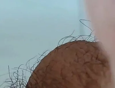 Extreme Open Hole Leaves the Glans Exposed.