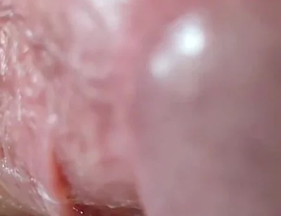 Opening the Scar of the Rough Frenulum!