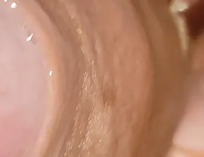 Large Cheese Accumulated in Close up of Glans