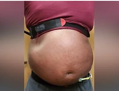N2o Belly Inflation