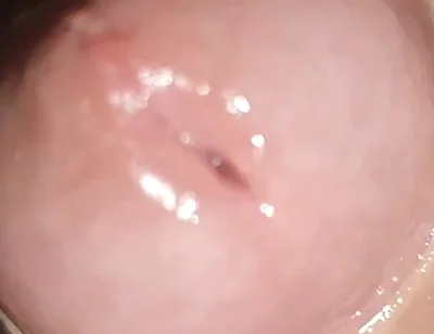 Maximum Dilation of Phimosis Cumming.