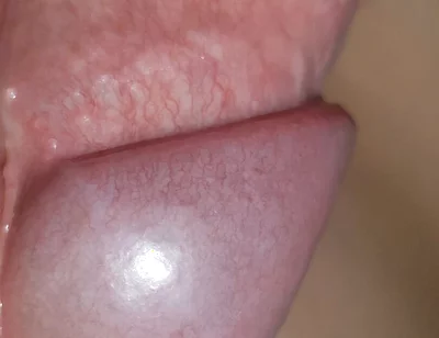 Amazing Upright Rough Venous Frenulum