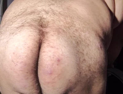 Fat Obese Butt
