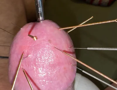Acupuncture - Orgasm!