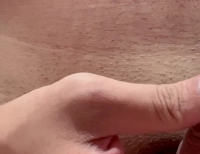 Papaya Seeds Inserted Into the Urethra
