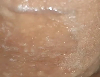 Scrotal Phimosis Results in an Extremely Hot Orgasm.