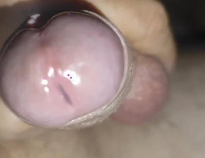 Scrotal Phimosis Results in an Extremely Hot Orgasm.