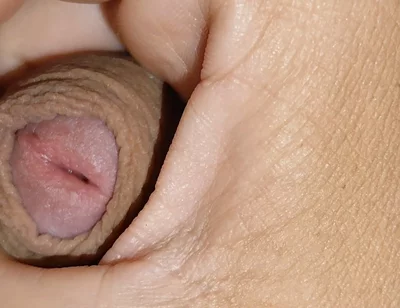Amazing Dilator Vessel Has Disproportionate Increase.