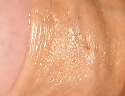 Difficult Fluid Control Due to Straight Phimosis.